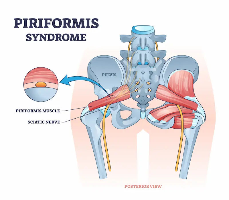What Leads To Signs Of Piriformis Syndrome Treatment